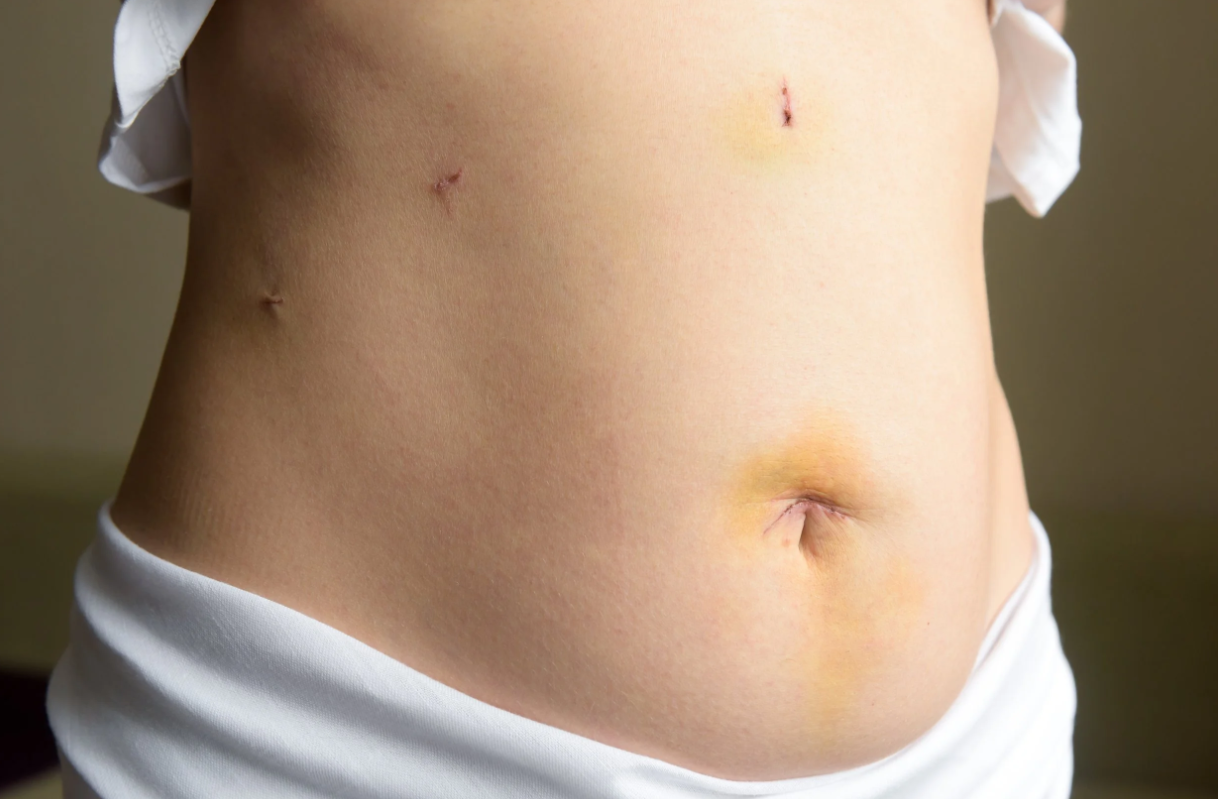 persona con cicatrices de laparoscopia